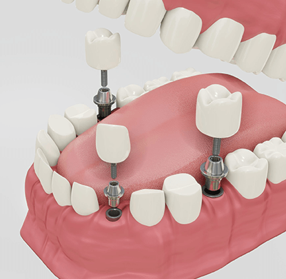 Dental İmplant